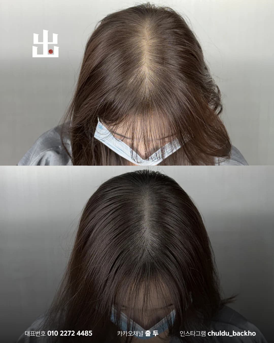 여성 가르마·정수리 두피문신 시술 전후 비교