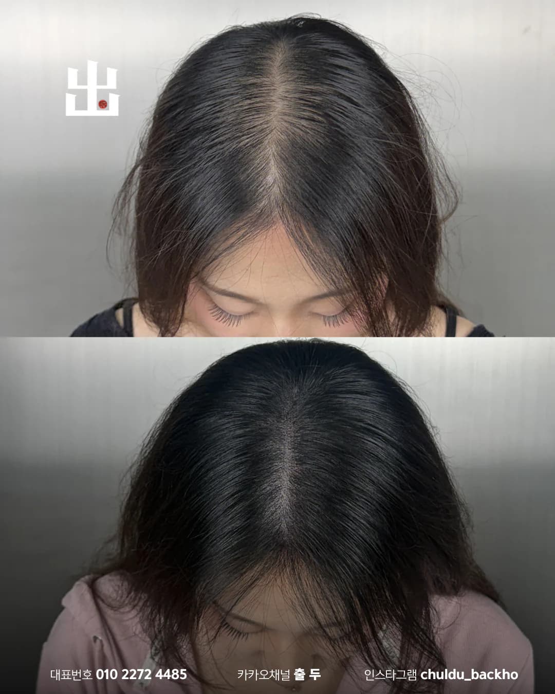 여성 앞 가르마 두피문신 시술 전후 비교