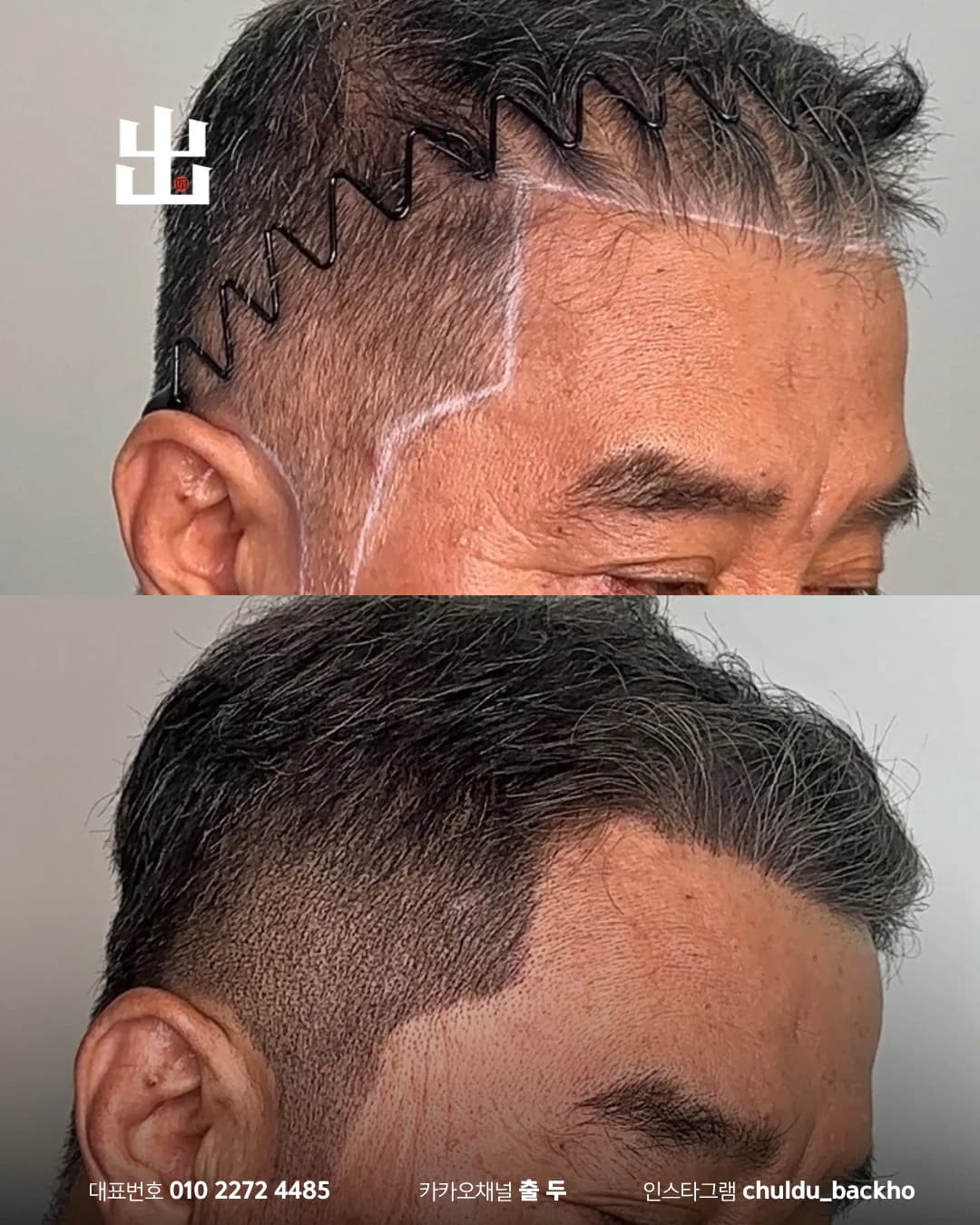 중년 남성 관자놀이 헤어라인 두피문신 시술 전후 비교