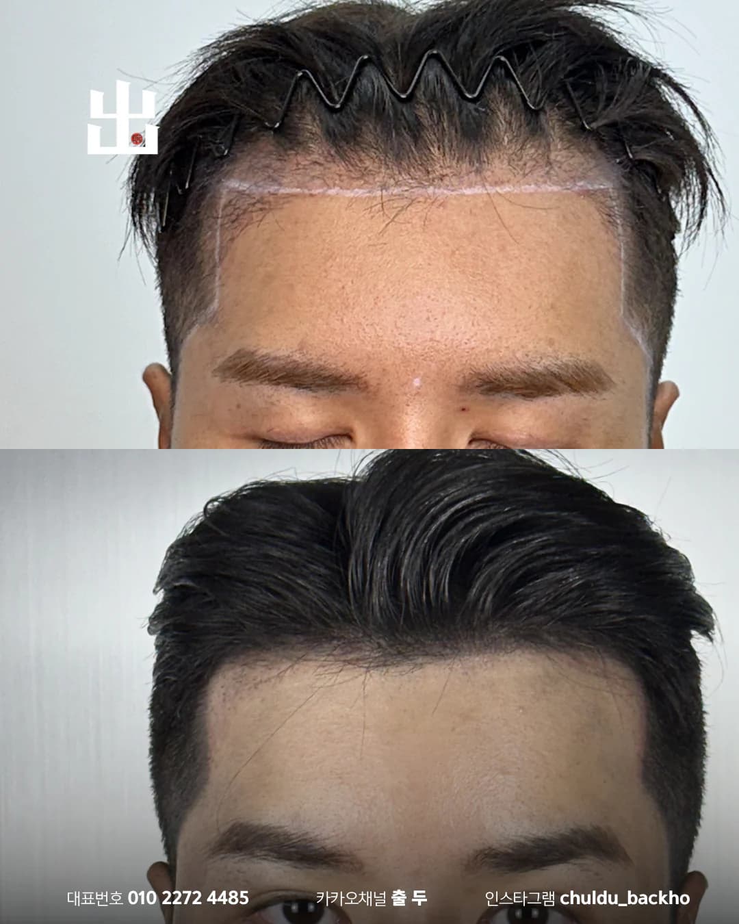 남성 앞 헤어라인 정면 두피문신 시술 전후 비교