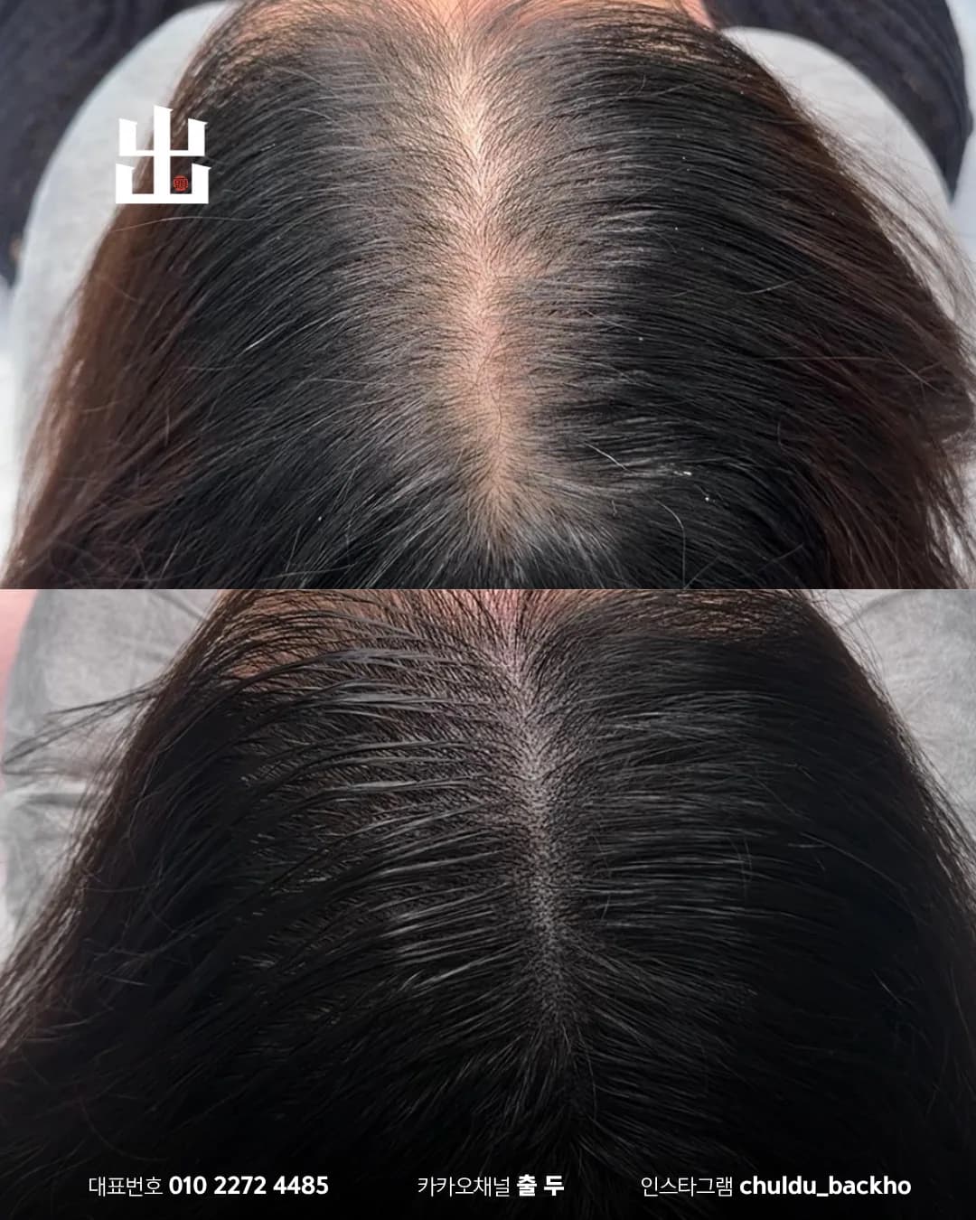 여성 가르마 두피문신 두피 근접 시술 전후 비교