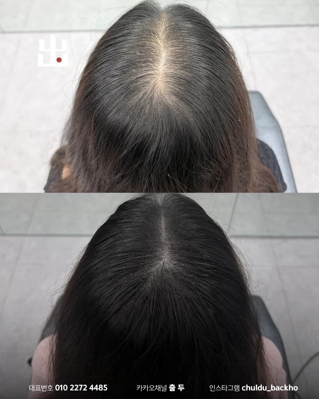 여성 가르마 두피문신 위에서 내려다본 정수리 시술 전후 비교