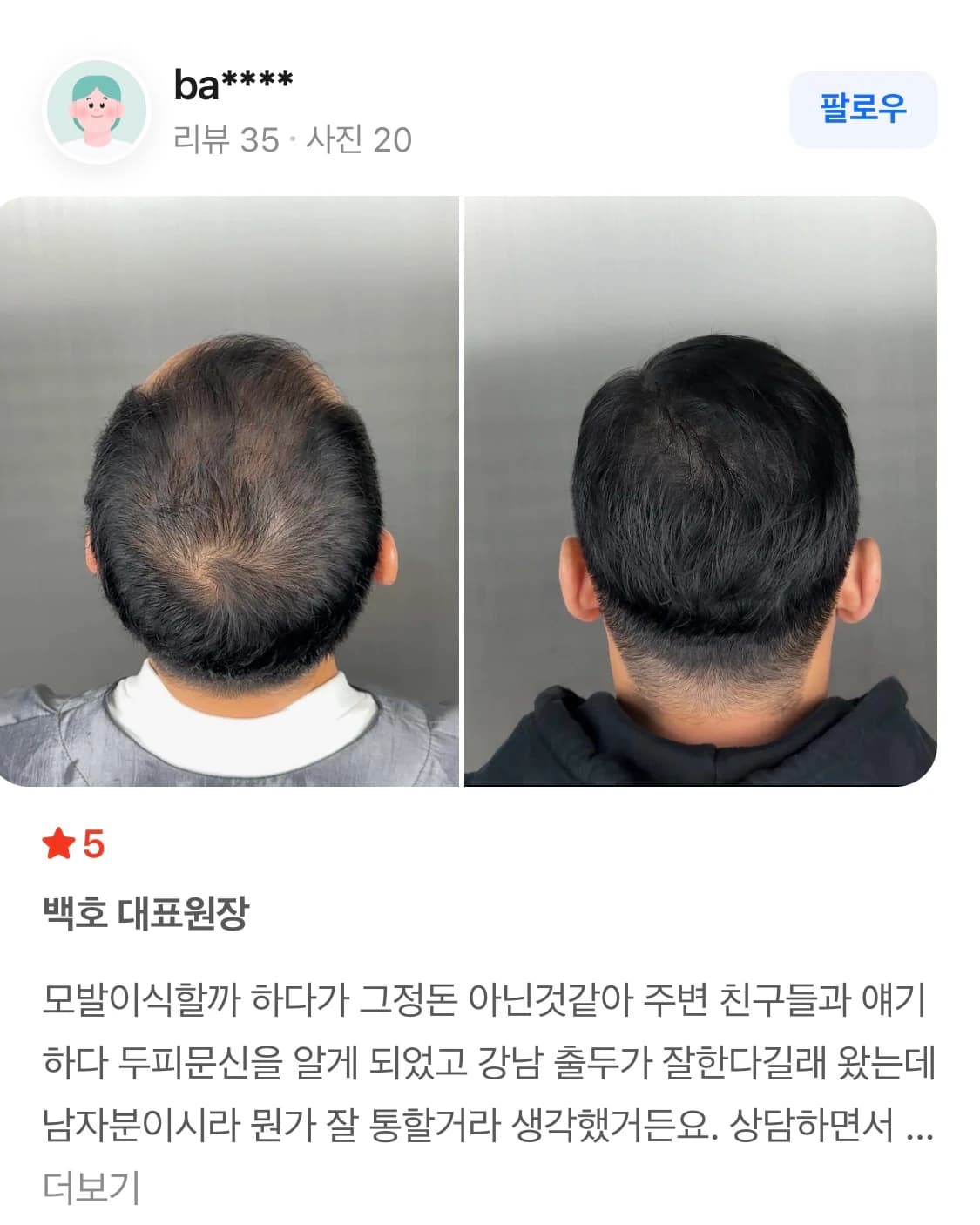 네이버 플레이스 리뷰 캡처 — 남성 정수리 두피문신 시술 전후 사진과 후기