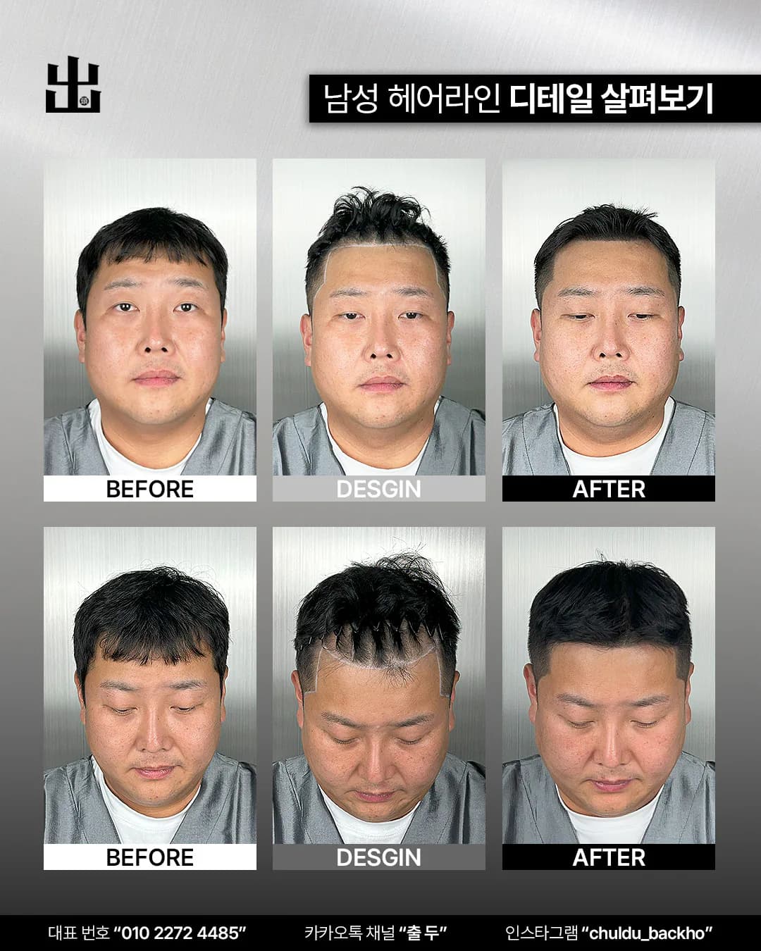 남성 헤어라인 두피문신 정면·정수리의 시술 전, 디자인, 시술 후 비교