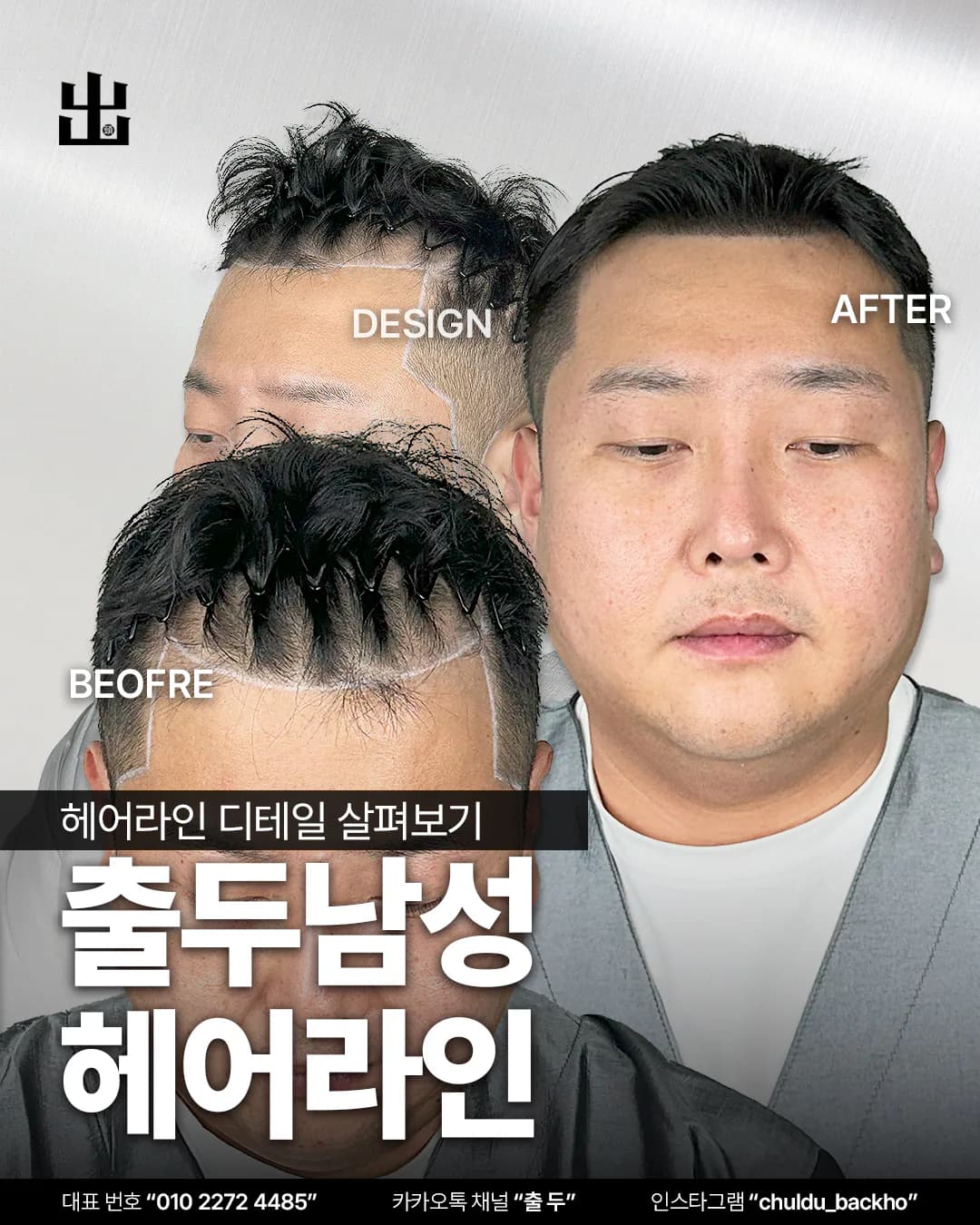 남성 헤어라인 두피문신 시술 전후 사진을 모은 표지 이미지